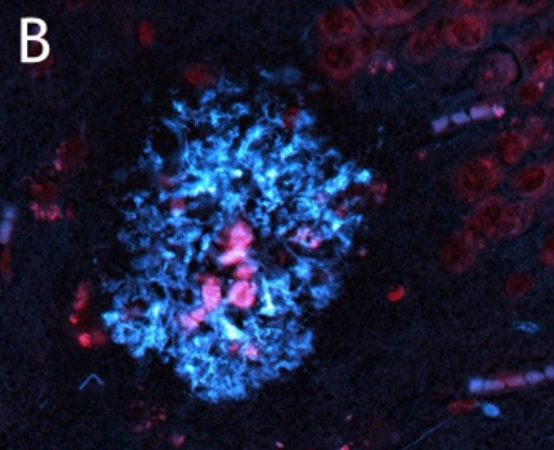 Plaque in AD brain consisting of the protein amyloid-beta (blue), a toxic protein contributing to pathology