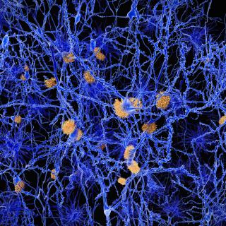 Amyloid beta (in yellow) aggregating around neurons in brain (in blue).